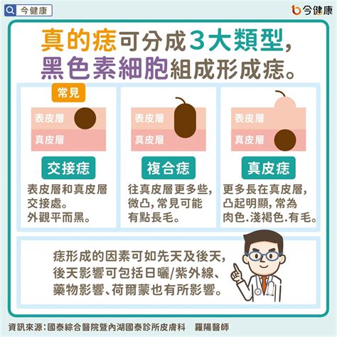 為甚麼會長痣|是痣？還是皮膚癌？皮膚科醫師教你揪出「假的痣」，。